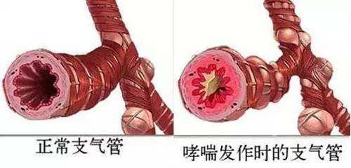 哮喘1.jpg