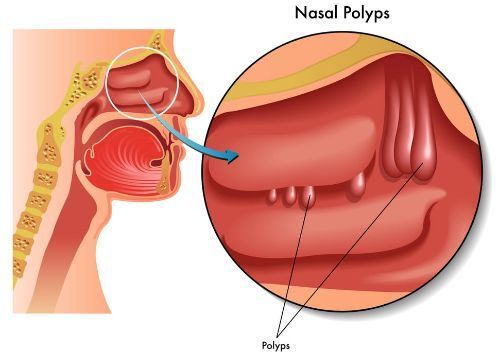 慢性鼻-鼻窦炎伴鼻息肉